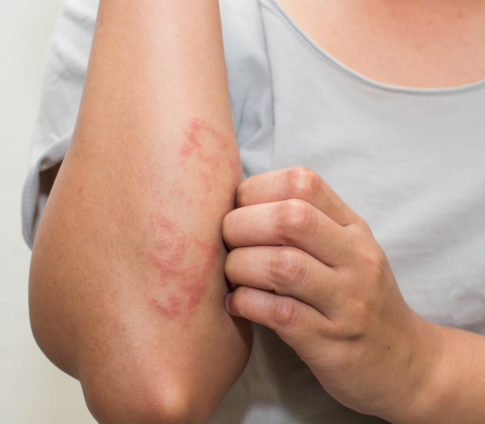 Atopic Dermatitis (Eczema)